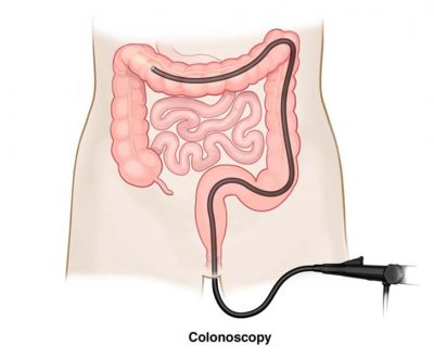 colonoscopy_large